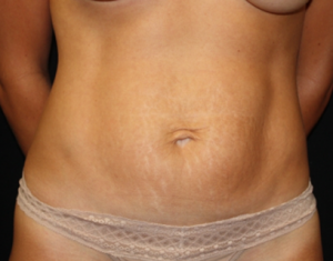 Tummy Tuck Before & After Patient #24450