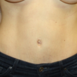 Tummy Tuck Before & After Patient #24450