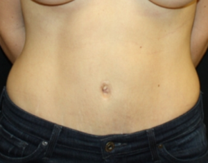 Tummy Tuck Before & After Patient #24450