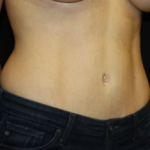 Tummy Tuck Before & After Patient #24450