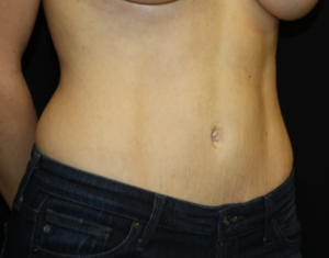 Tummy Tuck Before & After Patient #24450