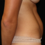 Tummy Tuck Before & After Patient #24450