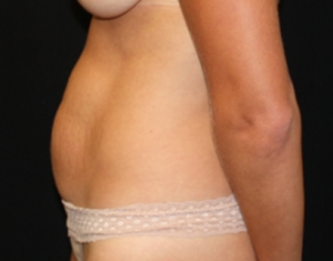 Tummy Tuck Before & After Patient #24450