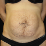 Tummy Tuck Before & After Patient #24513