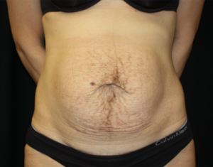 Tummy Tuck Before & After Patient #24513