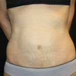 Tummy Tuck Before & After Patient #24513