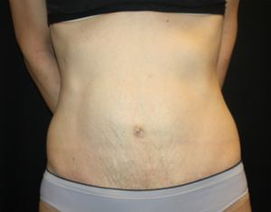 Tummy Tuck Before & After Patient #24513