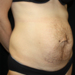 Tummy Tuck Before & After Patient #24513