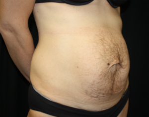 Tummy Tuck Before & After Patient #24513