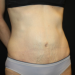 Tummy Tuck Before & After Patient #24513