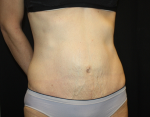 Tummy Tuck Before & After Patient #24513