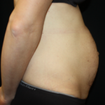 Tummy Tuck Before & After Patient #24513