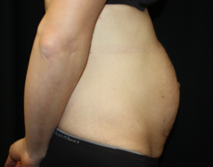 Tummy Tuck Before & After Patient #24513