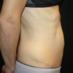 Tummy Tuck Before & After Patient #24513