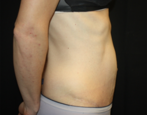 Tummy Tuck Before & After Patient #24513