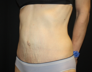 Tummy Tuck Before & After Patient #24513