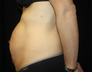 Tummy Tuck Before & After Patient #24513