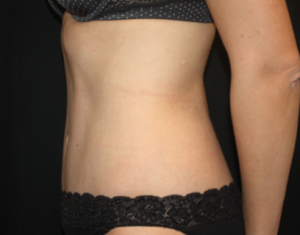 Tummy Tuck Before & After Patient #24514