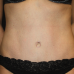 Tummy Tuck Before & After Patient #24514