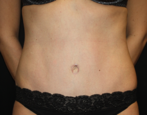Tummy Tuck Before & After Patient #24514