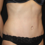 Tummy Tuck Before & After Patient #24514