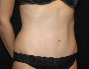 Tummy Tuck Before & After Patient #24514