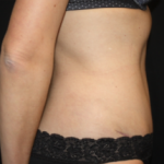 Tummy Tuck Before & After Patient #24514