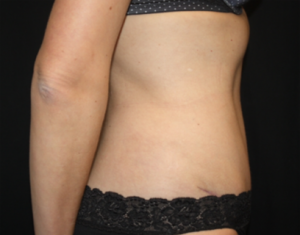 Tummy Tuck Before & After Patient #24514