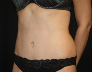 Tummy Tuck Before & After Patient #24514