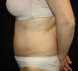 Tummy Tuck Before & After Patient #24536