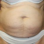 Tummy Tuck Before & After Patient #24536