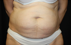 Tummy Tuck Before & After Patient #24536