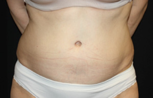 Tummy Tuck Before & After Patient #24536