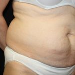 Tummy Tuck Before & After Patient #24536