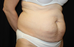 Tummy Tuck Before & After Patient #24536