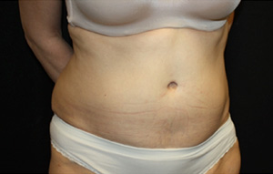 Tummy Tuck Before & After Patient #24536