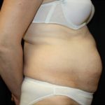 Tummy Tuck Before & After Patient #24536