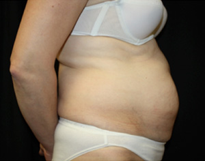 Tummy Tuck Before & After Patient #24536