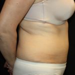 Tummy Tuck Before & After Patient #24536