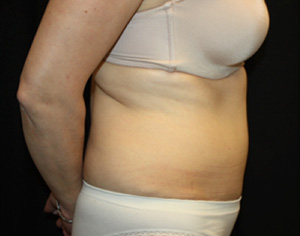 Tummy Tuck Before & After Patient #24536