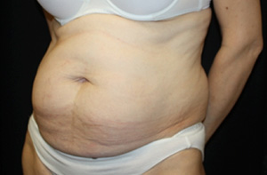 Tummy Tuck Before & After Patient #24536