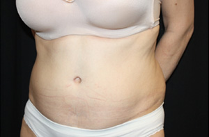 Tummy Tuck Before & After Patient #24536