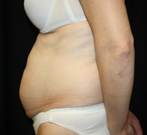 Tummy Tuck Before & After Patient #24536