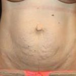 Tummy Tuck Before & After Patient #24538