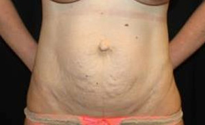 Tummy Tuck Before & After Patient #24538