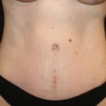 Tummy Tuck Before & After Patient #24538