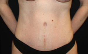 Tummy Tuck Before & After Patient #24538