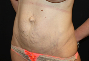 Tummy Tuck Before & After Patient #24538