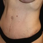 Tummy Tuck Before & After Patient #24538