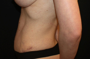 Tummy Tuck Before & After Patient #24538